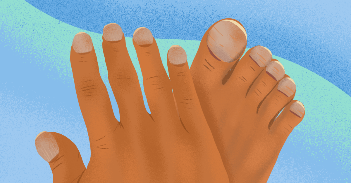 How Does Cystic Fibrosis Cause Clubbing of Fingers and Toes?