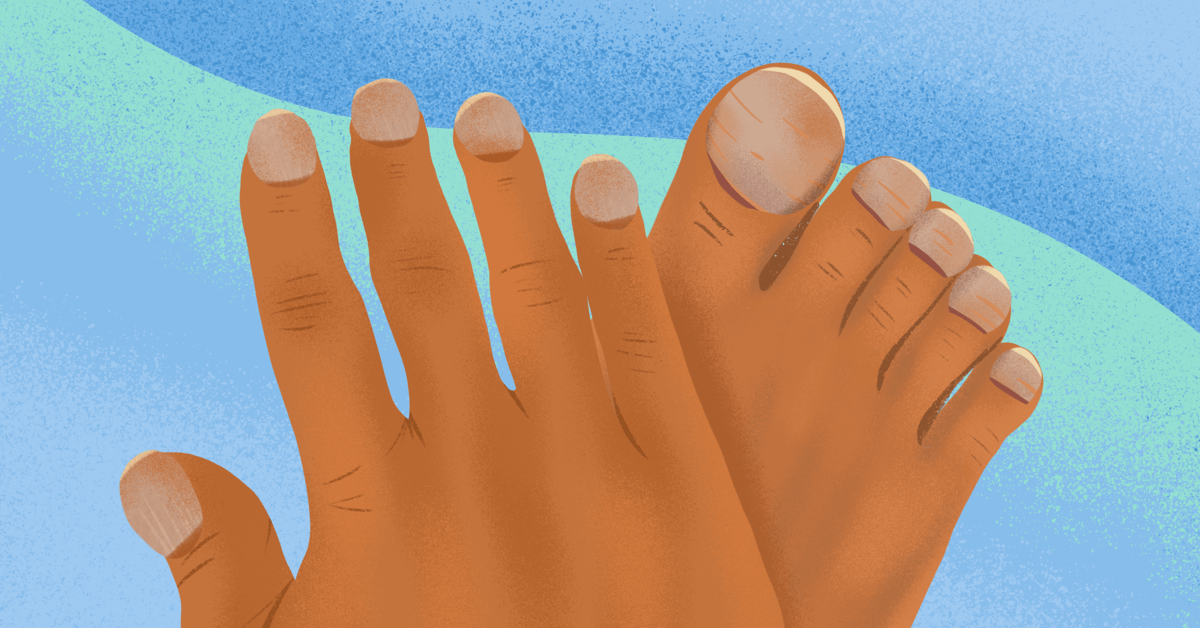 How Does Cystic Fibrosis Cause Clubbing Of Fingers And Toes 