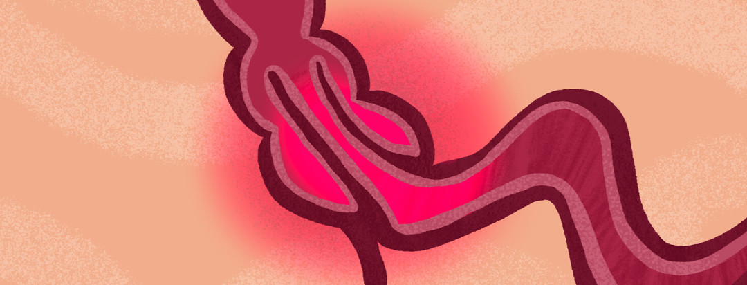 Close up of intussusception; bowels folded into each other with red highlighting areas of pain