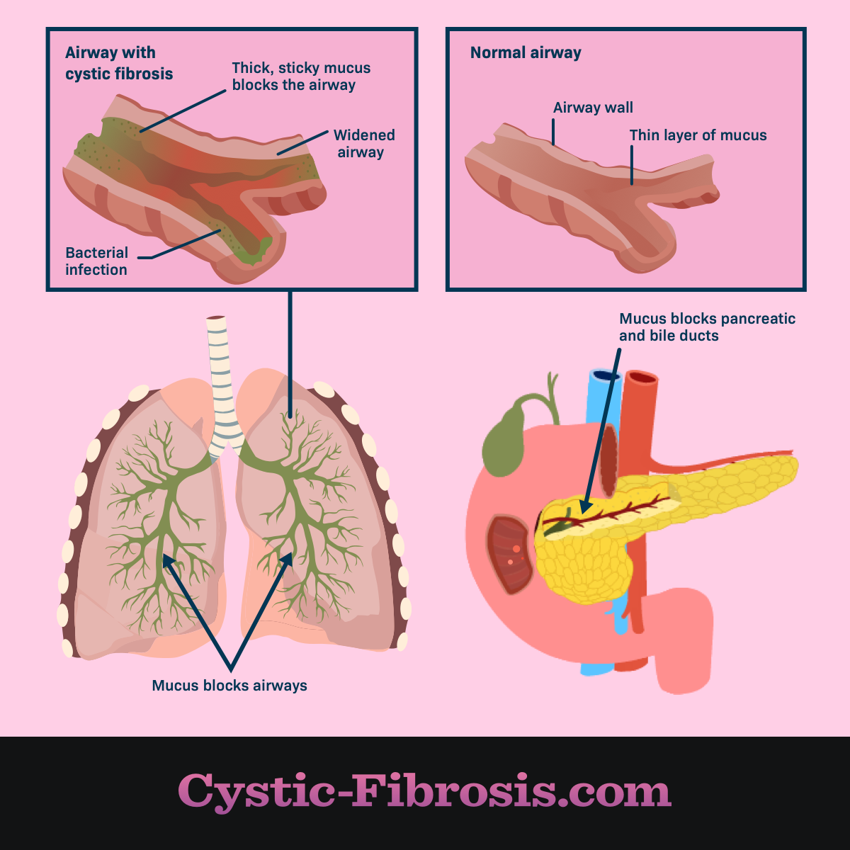 cystic fibrosis lung passageway compared to a normal airway