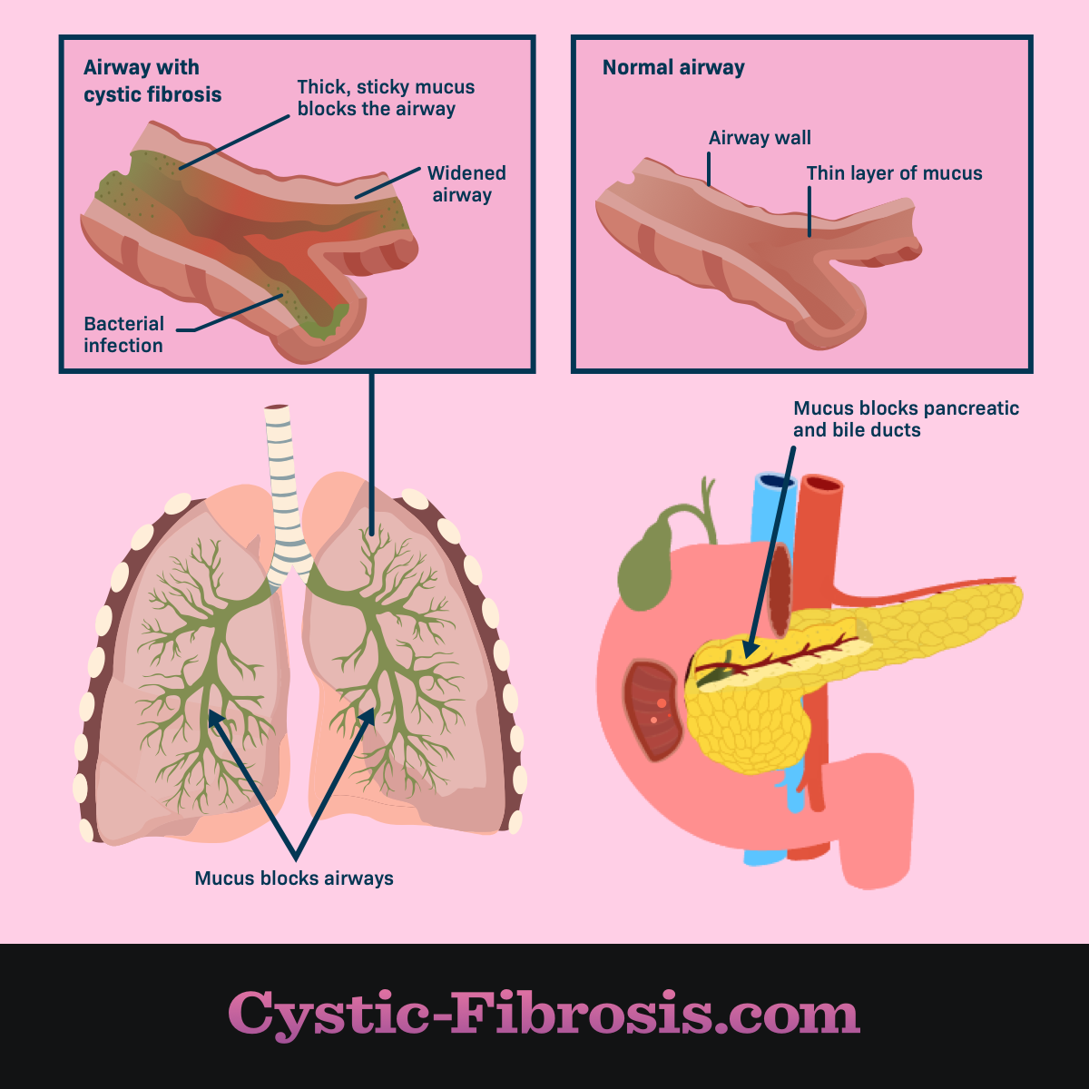 cystic fibrosis lungs diagram